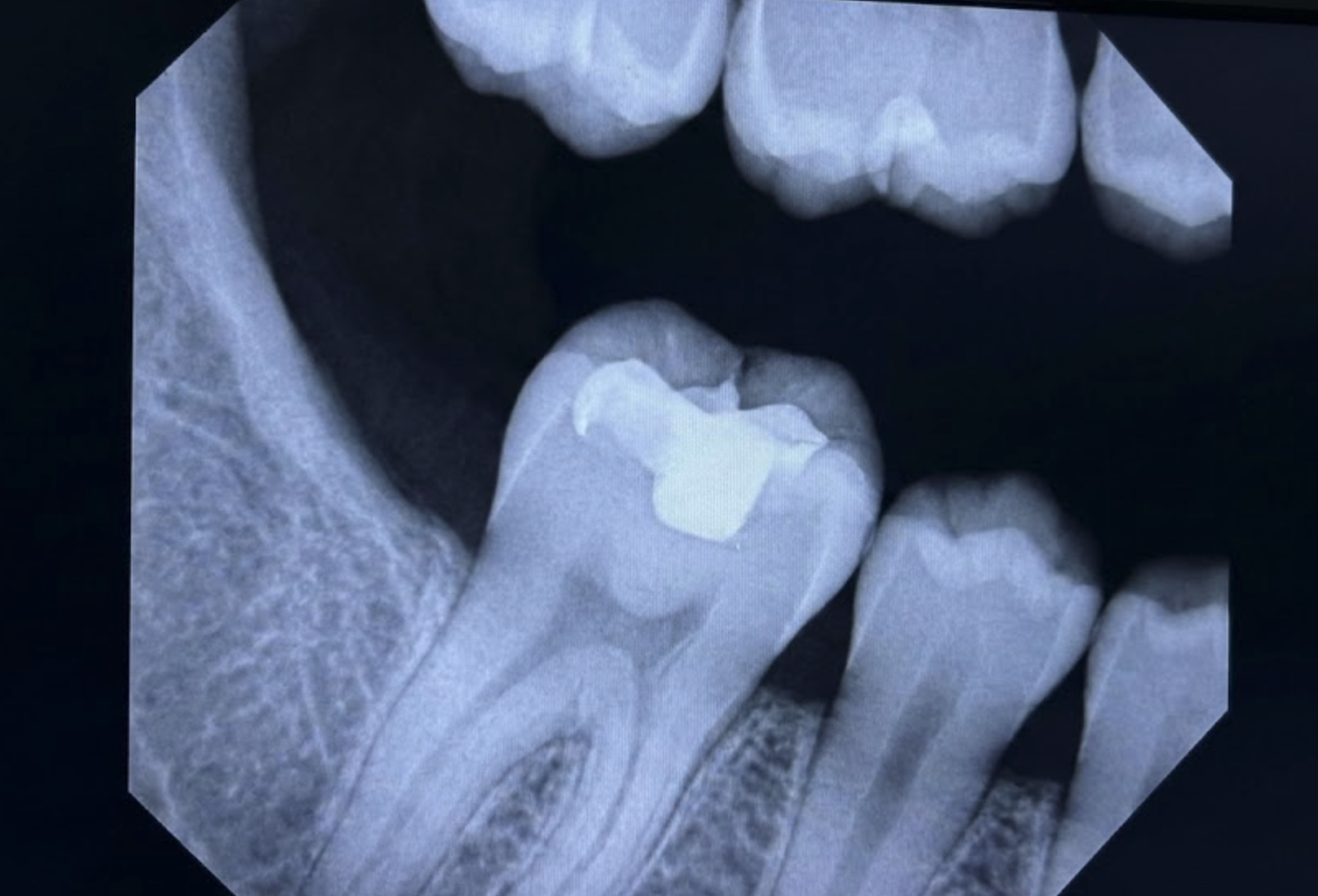 Dental Fillings