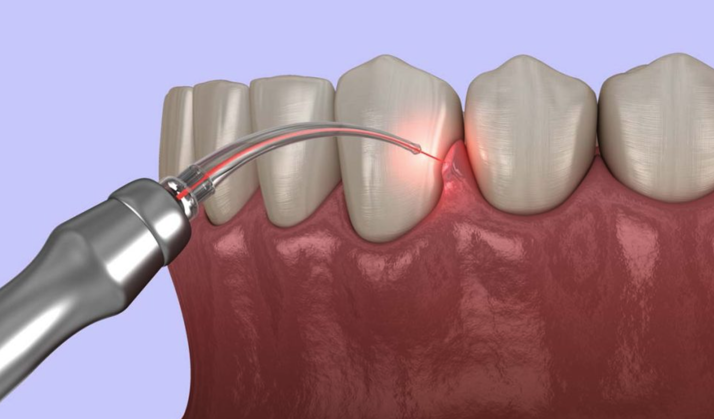 Laser Dentistry