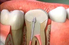 Root Canal Treatment
