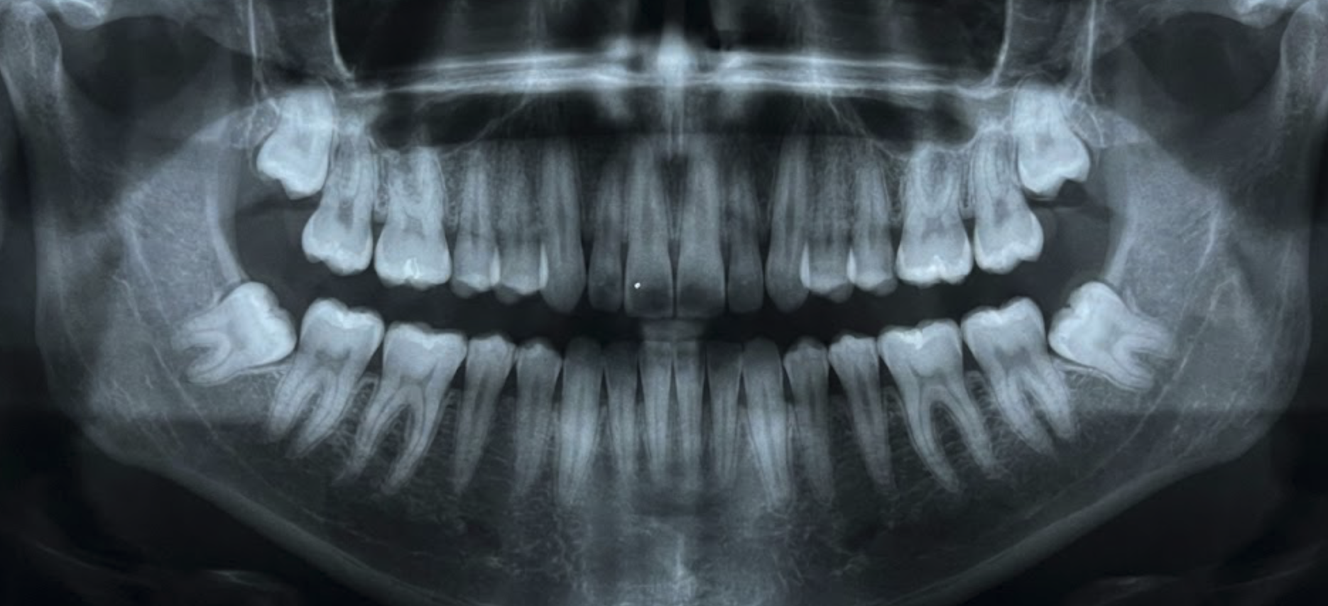 Wisdom Teeth Removal