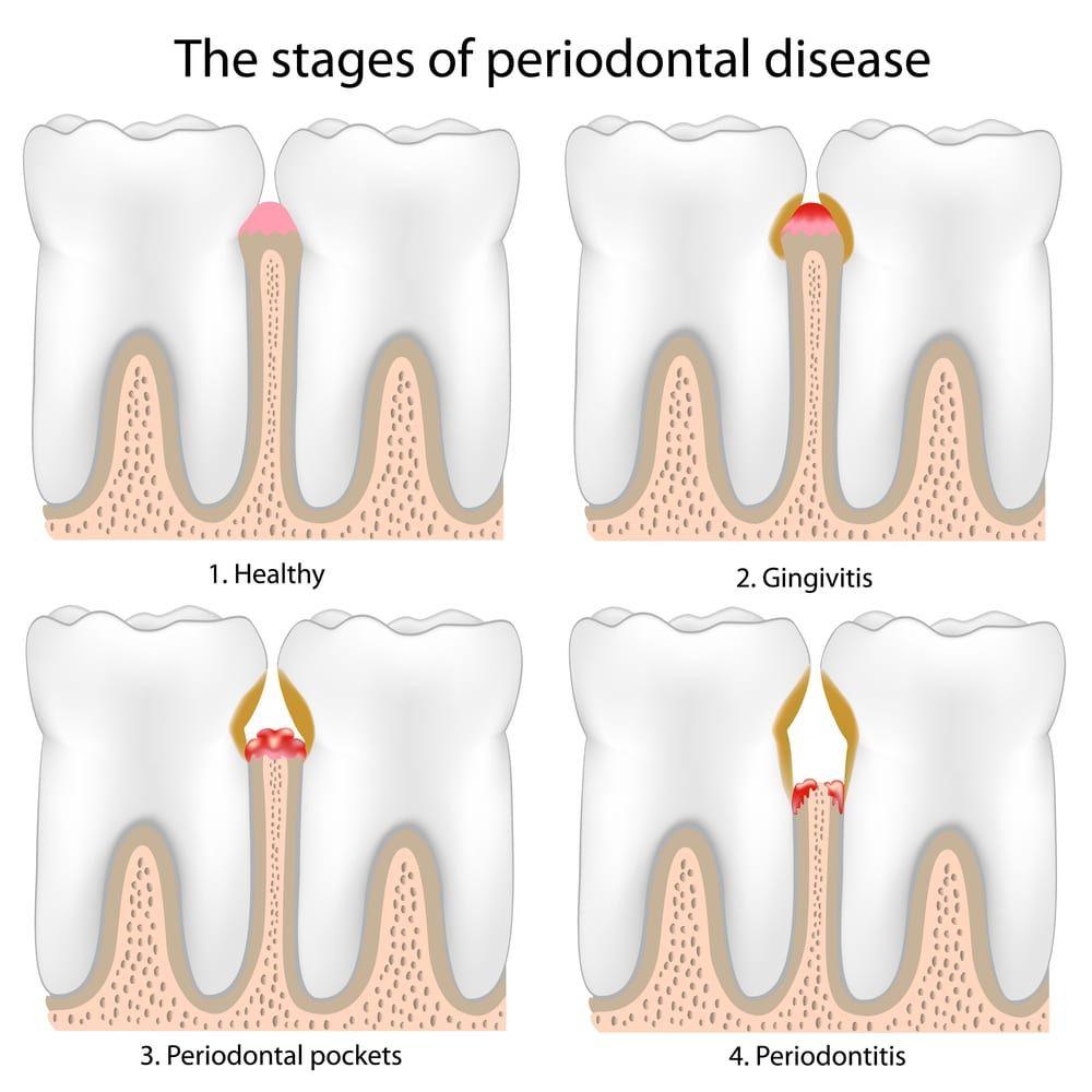 The Silent Epidemic: Understanding Gum Disease and How to Prevent It