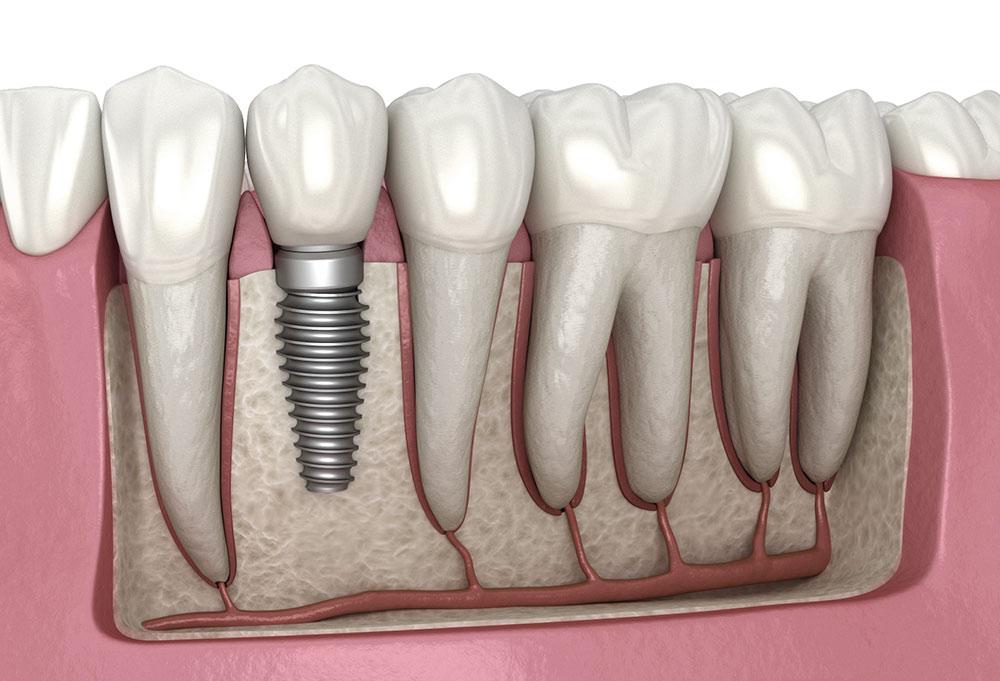 Dental Implants Near You | Serving Hocking, North Beach, Two Rocks & Mullaloo