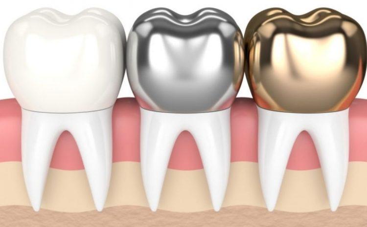 Dental Crowns in Hocking, North Beach, Two Rocks & Mullaloo