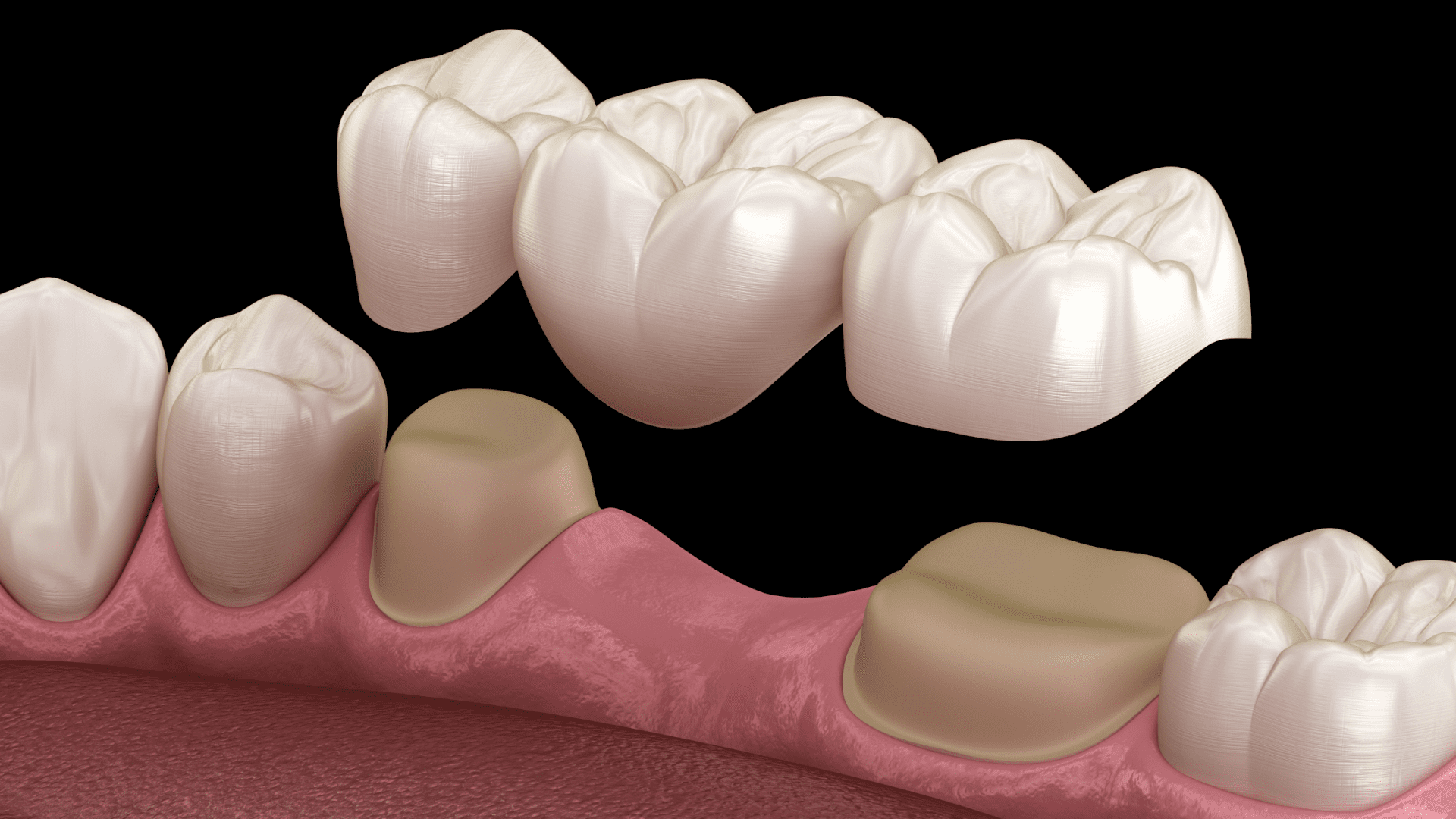 Dental Crowns & Bridges in Hocking, North Beach, Two Rocks & Mullaloo
