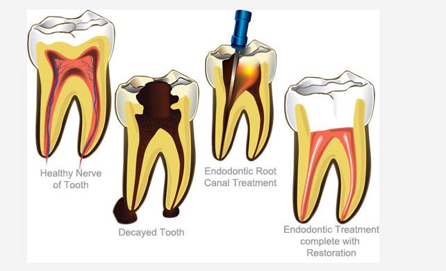 Root Canal Therapy in Hocking, North Beach, Two Rocks & Mullaloo