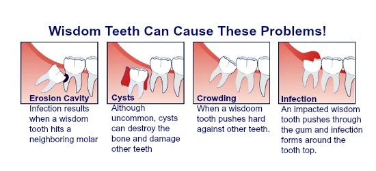 Wisdom Tooth Extraction: Benefits, Procedure & Recovery Guide