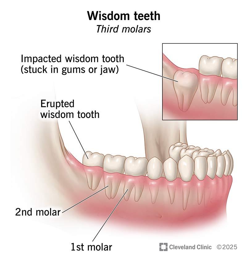 Wisdom Tooth Extraction in Hocking: Signs, Benefits & Local Treatment Options